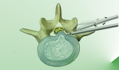 Percutaneous-Endoscopic-Discectomy1