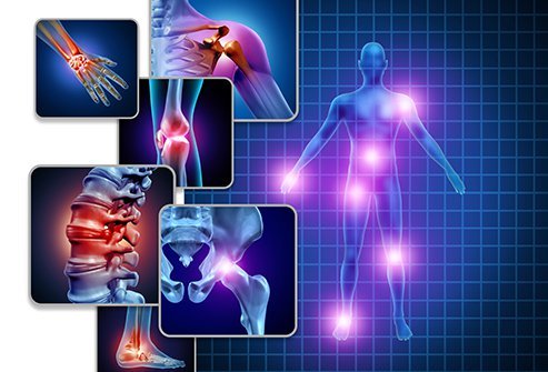 Fibromyalgia