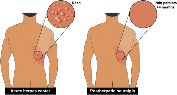 HerpeticNeuralgia