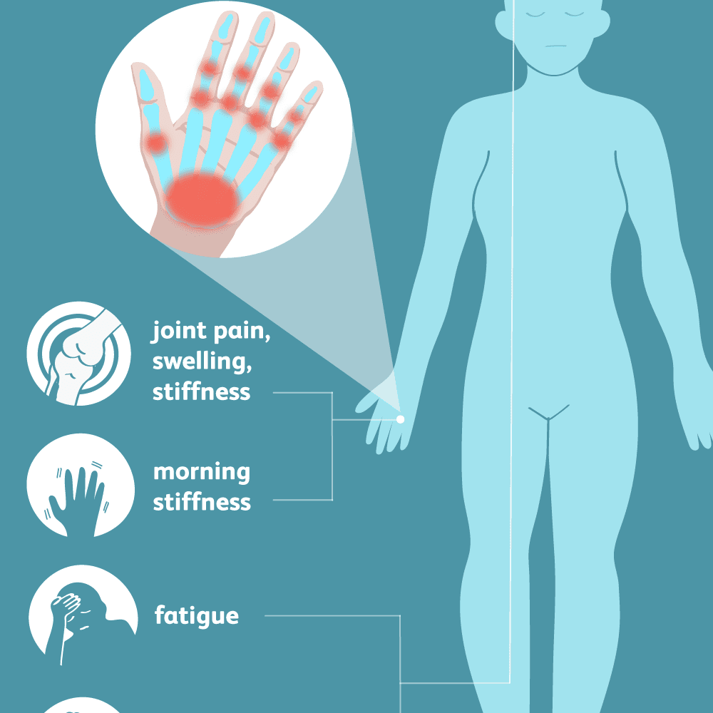 Rheumatoid Arthritis