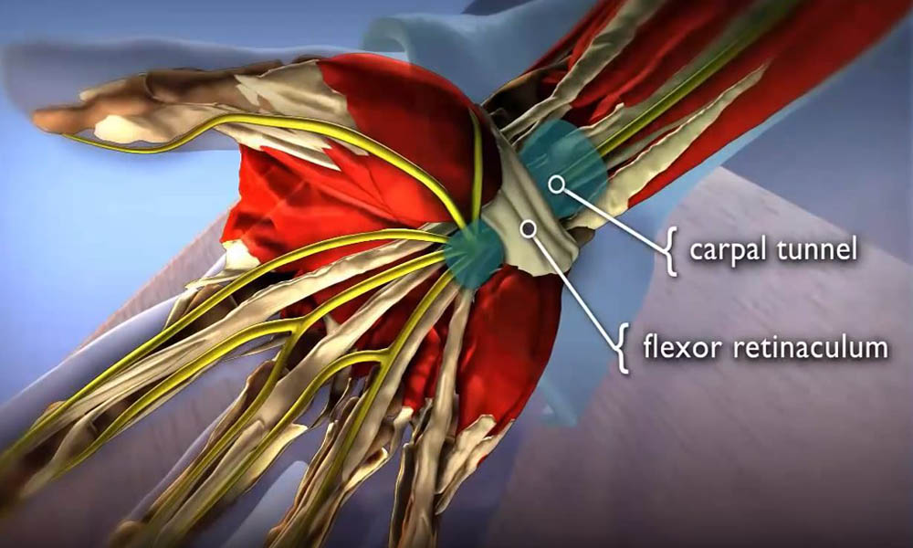 Carpal Tunnel Syndrome