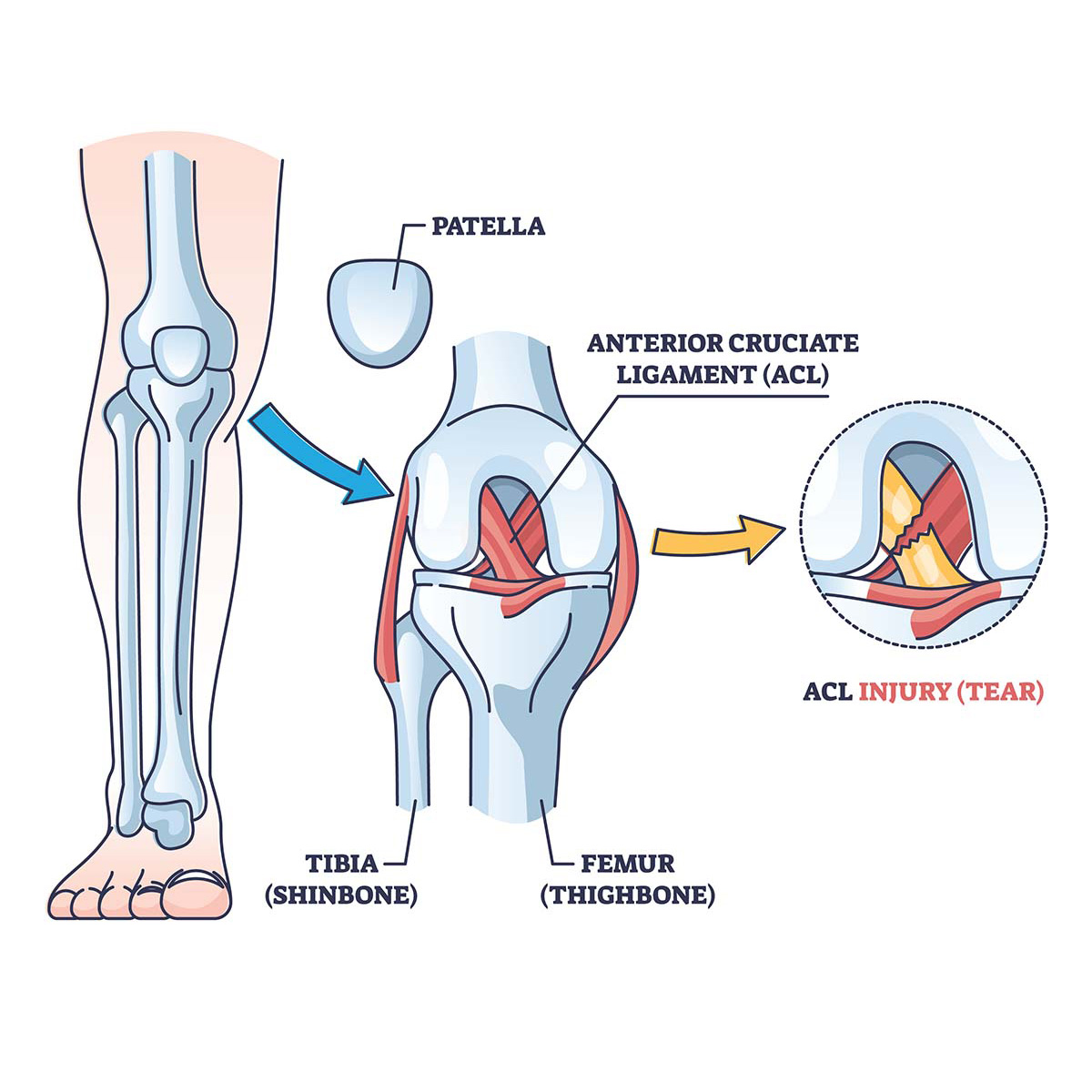 ligament-tear