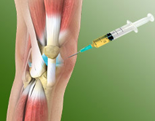 Prolotherapy